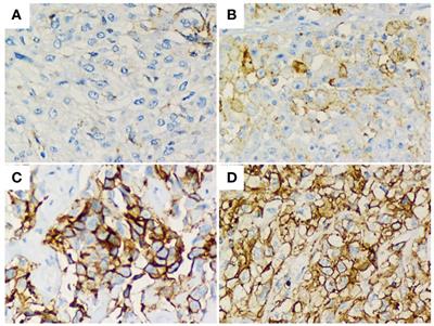 PD-L1 expression complements CALGB prognostic scoring system in malignant pleural mesothelioma